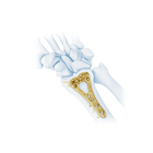 Orthopedic Implants Trauma Plate Distal Radius Multi-Axial Locking Plate