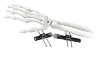 Orthopedic Wrist External Fixator Standard Single sided Integrated